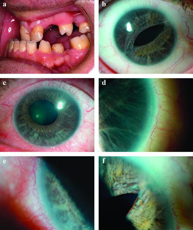 Medicine Axenfeldrieger Syndrome Handwiki