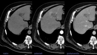 Example of multi-phase contrast-enhanced CT scan of the liver, which is used for LIRADS criteria.