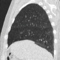 Spiral 4DCT Lung (Lateral).gif