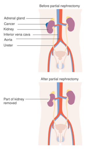 Diagram showing before and after a partial nephrectomy CRUK 102.svg