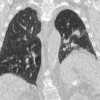 Spiral 4DCT Lung (Post).gif