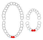 Mandibular central incisors01-01-06.png
