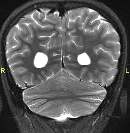 File:Rhombencephalosynapsis MRI.jpg