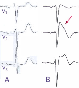 File:Brugada EKG Schema.jpg