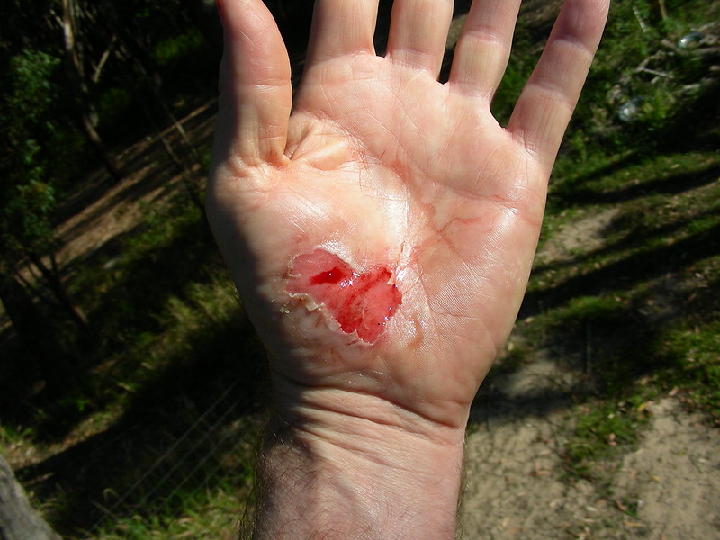 File:Bicycle injury - Hand Abrasion, Day 1.jpg