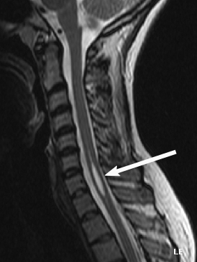 File:Syringomyelia (with arrow).png