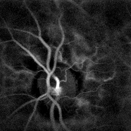 File:Branch retinal vein occlusion revealed by laser Doppler imaging.gif