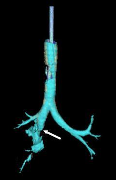 Tracheobronchial rupture 3D CT 3.jpg