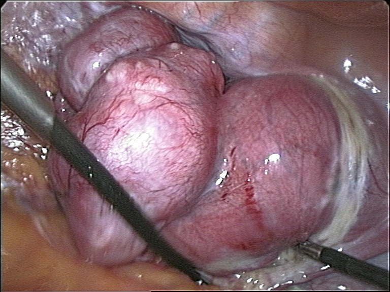 File:Total laparoscopical hysterectomy.jpg