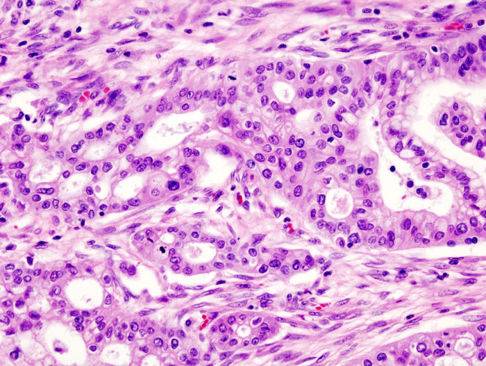 File:Pancreas adenocarcinoma (4) Case 01.jpg