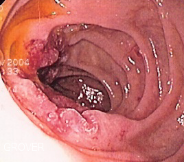File:Duodenal adenocarcinoma.png