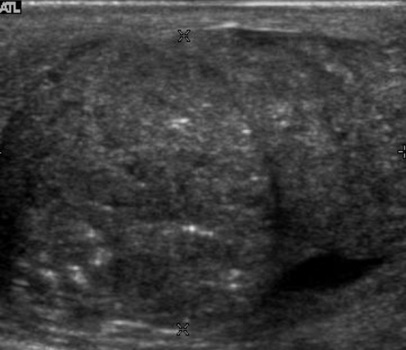File:Ultrasonography of embryonal cell carcinoma.jpg