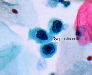 File:Dysplastic cells.jpg
