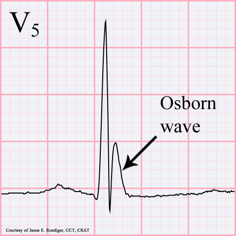 File:Osborn wave.gif