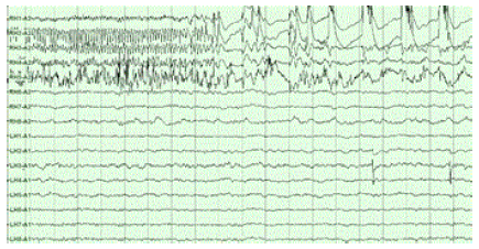 File:Epilepsy- right hippocampal seizure onset.png