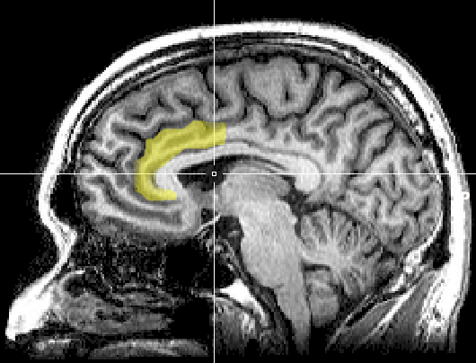 File:MRI anterior cingulate.png