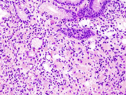 File:Gastric signet ring cell carcinoma histopatholgy (1).jpg