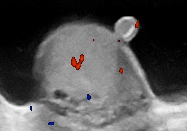 File:Ultrasonography of an appendix on a testicle in a hydrocele.jpg