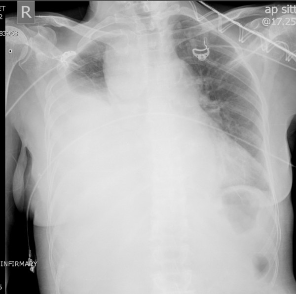File:Massive right hemothorax.jpg