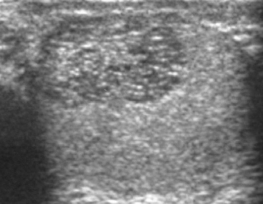File:Scrotal ultrasonography of tubular ectasia mimicking a tumor.jpg