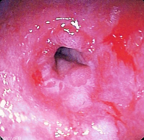 File:Peptic stricture.png
