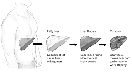 File:Stages of Liver disease NIDDK NIH.gif