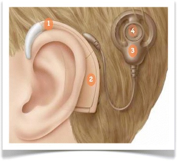 File:Cochlear-implant-external-part.jpg