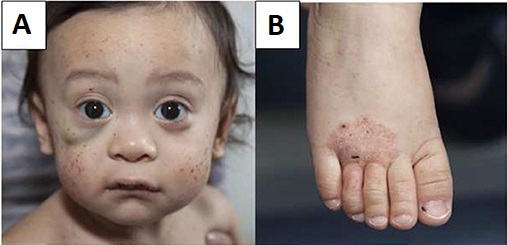File:Wiskott–Aldrich syndrome petechiae, hematoma and eczema.jpg
