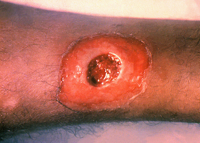 File:A diphtheria skin lesion on the leg. PHIL 1941 lores.jpg
