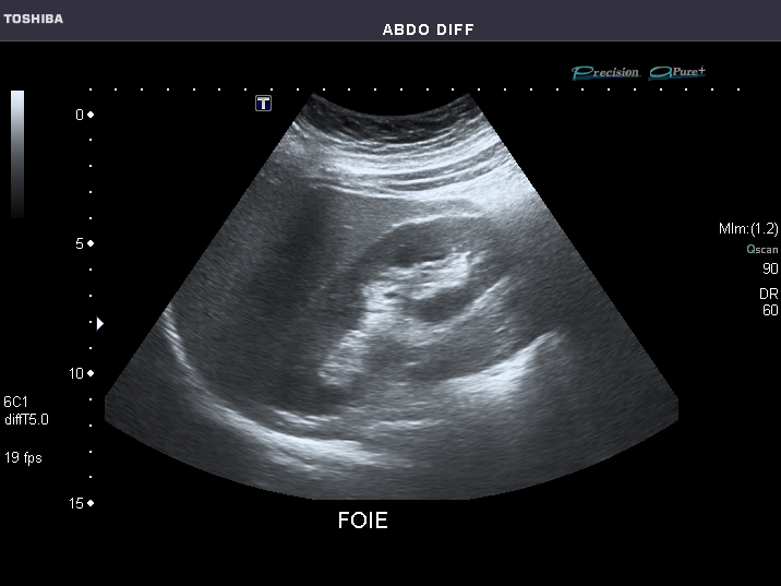 File:Abdominal Ultrasound Full Exam 26.jpg
