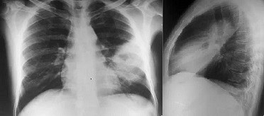 File:Melioidosis PA and lateral X rays.jpg