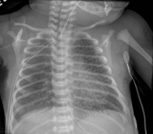 CXR-Pulmonary interstitial emphysema.jpg