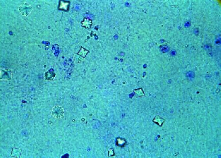 File:Calcium oxalate crystals in urine.jpg