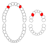 Maxillary canines01-01-06.png