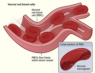 File:Modified sickle cell 01.jpg