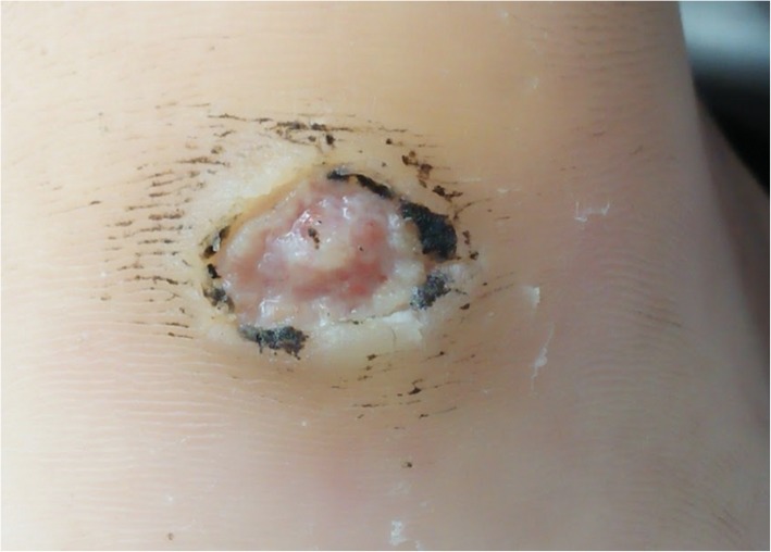File:Plantar yaw with moist yellow crusted erosion overlying pink granulation tissue.jpg