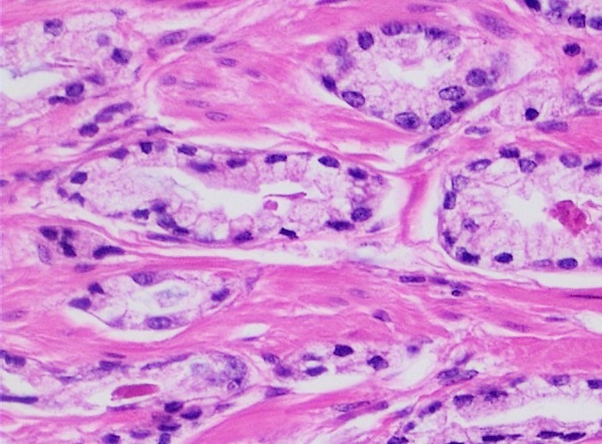 File:Prostate adenocarcinoma - acinar pattern.jpg
