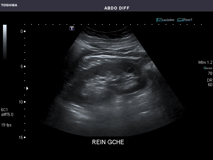 File:Abdominal Ultrasound Full Exam 51.jpg