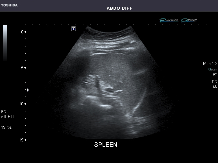 File:Abdominal Ultrasound Full Exam 54.jpg