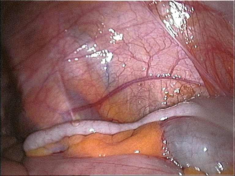 File:Appendix vermiformis.jpg