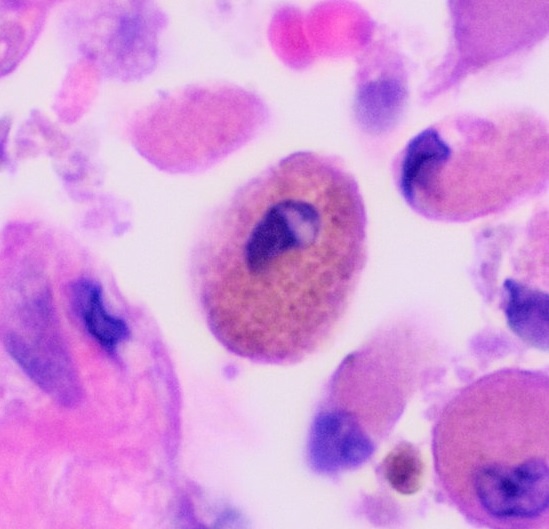 File:Histopathology of a smoker's macrophage.jpg