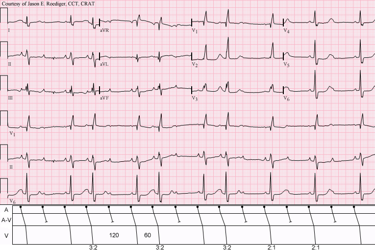 File:Sinus rhythm with 3-to-2 and 2-to-1 Type II A-V block.png