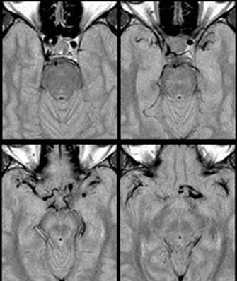 Dolichoectasia of the left internal carotid artery patientcase image2.jpg