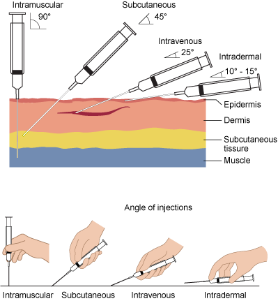 File:Needle-insertion-angles-1.png