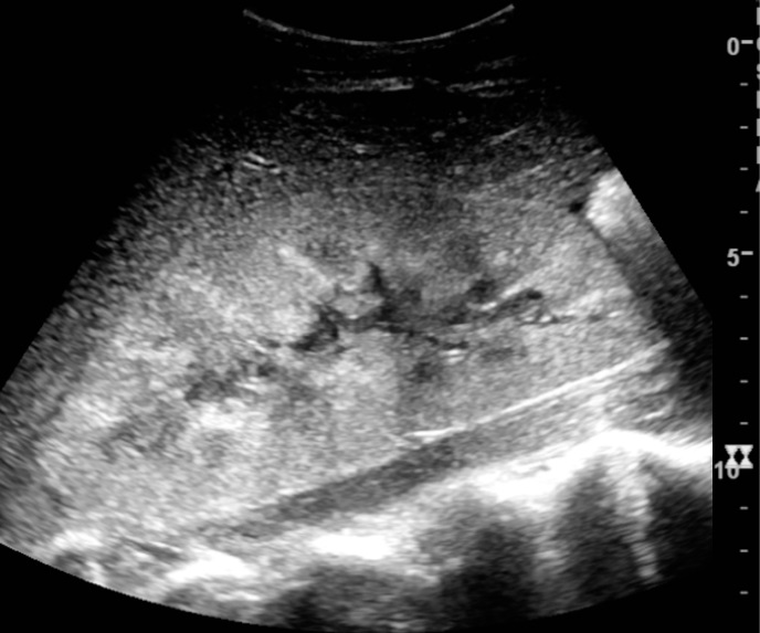 File:Ultrasonography of postoperative renal failure.jpg