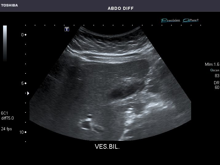 File:Abdominal Ultrasound Full Exam 18.jpg