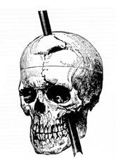 Drawing of trajectory of tamping iron took through Phineas Gage's skull.