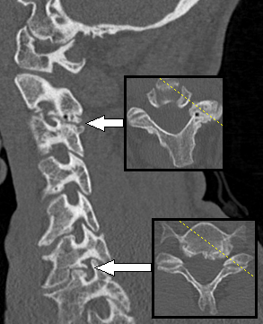 File:CT of spondylosis causing radiculopathy.png
