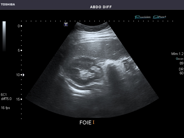 File:Abdominal Ultrasound Full Exam 20.jpg