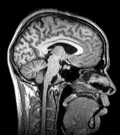 File:Sagittal brain MRI.jpg
